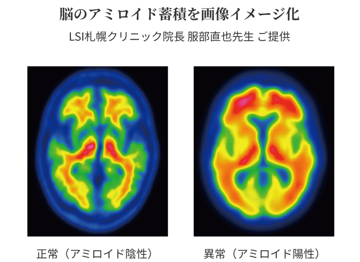 脳のアミロイド蓄積を画像イメージ化